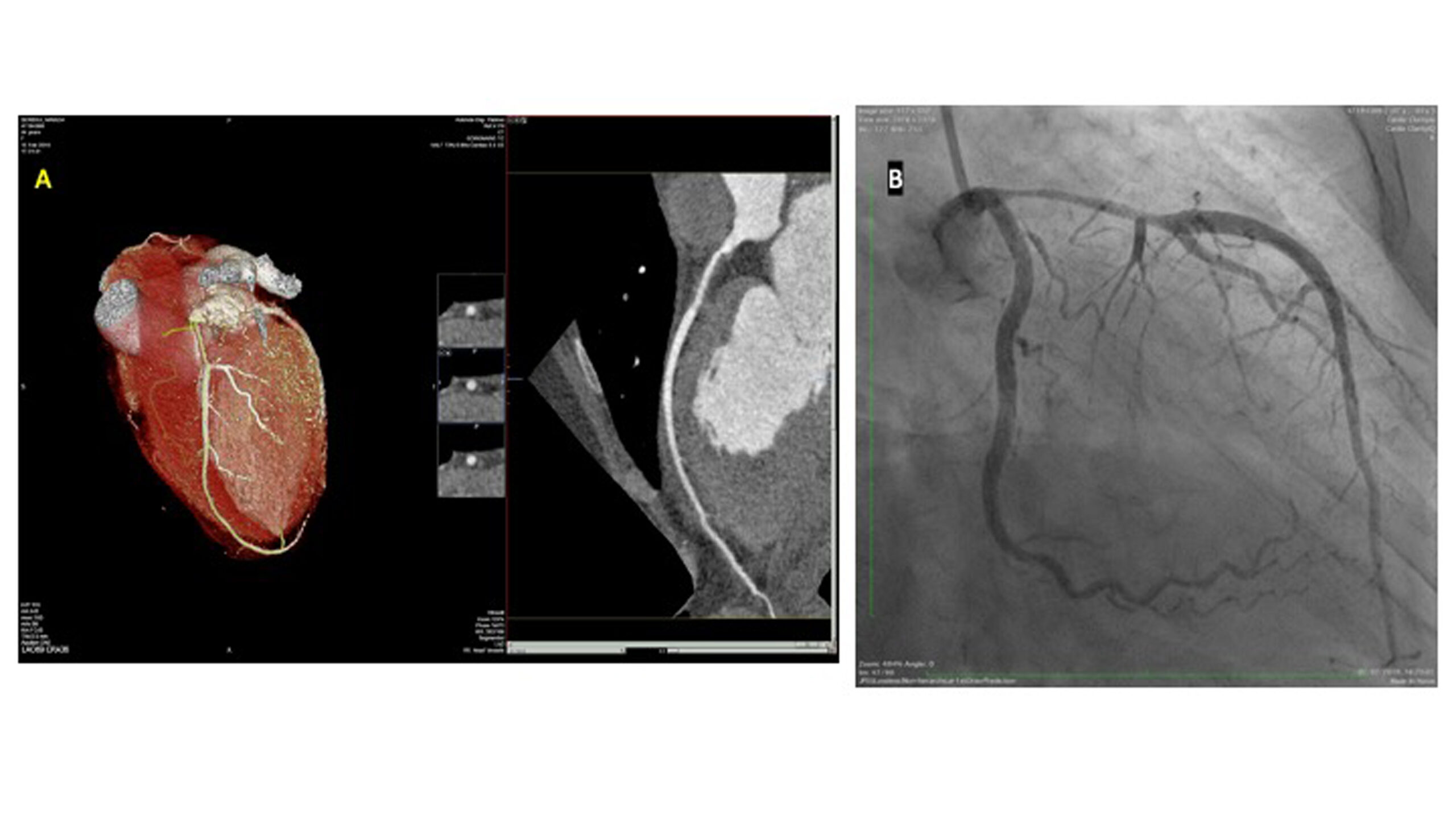 Le dissezioni coronariche spontanee: imaging coronarico invasivo o non invasivo?