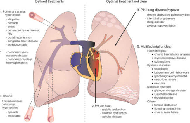 Ipertensione arteriosa polmonare
